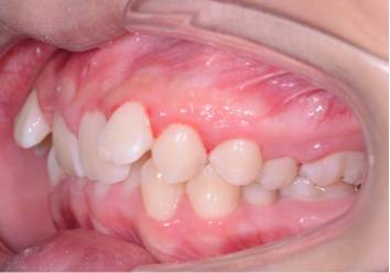 羡慕刘涛一口白牙?先看看她“美容冠”血泪史…