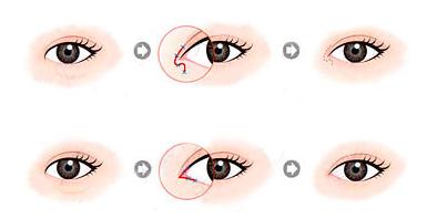 内眦赘皮的治疗方法?