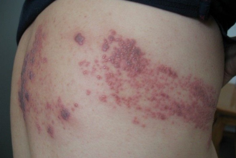 人体免疫受损或者紊乱后,水痘-带状疱疹病毒被激活后,导致神经节发炎