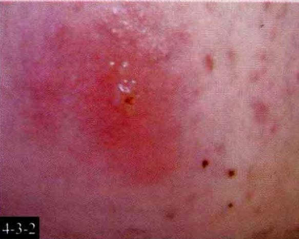 外生殖器,肛周等部位,皮疹为红斑的基础上粟粒至绿豆大小的簇集性水疱