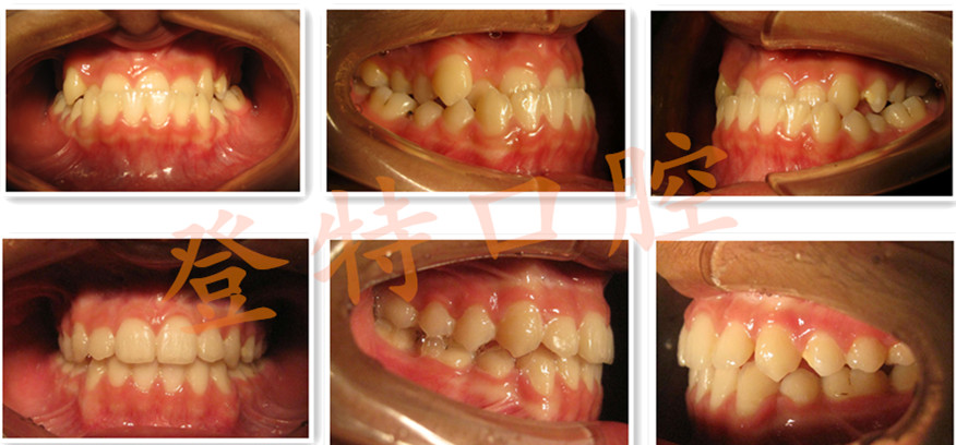 六大常见畸形牙及案例分享