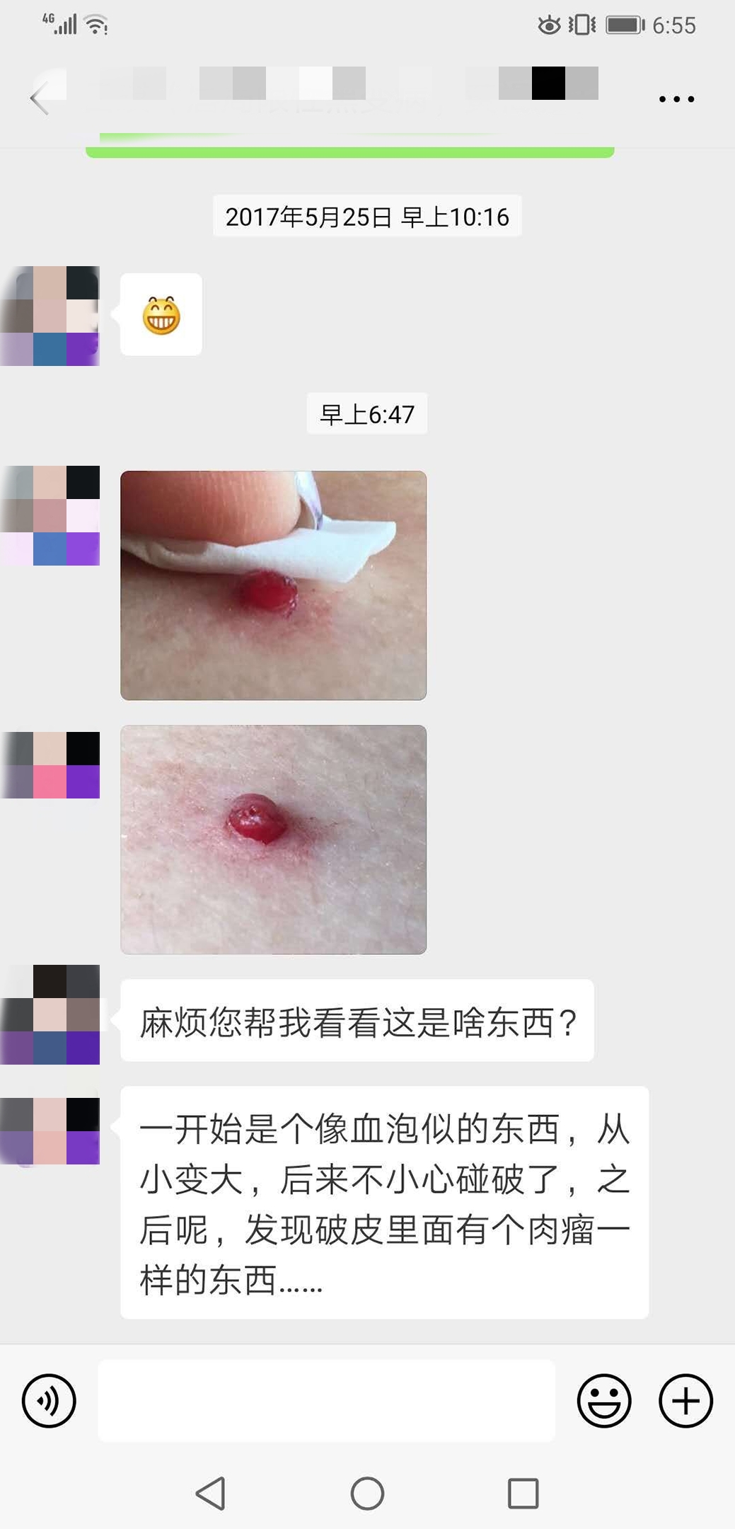 皮肤上的小血疱是啥东西?