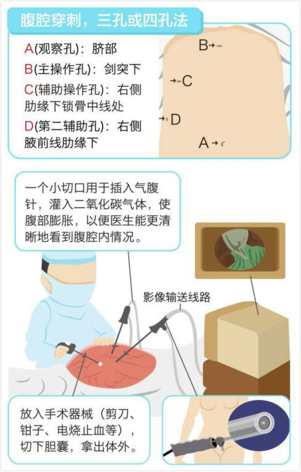 胆囊癌筛查和预防建议