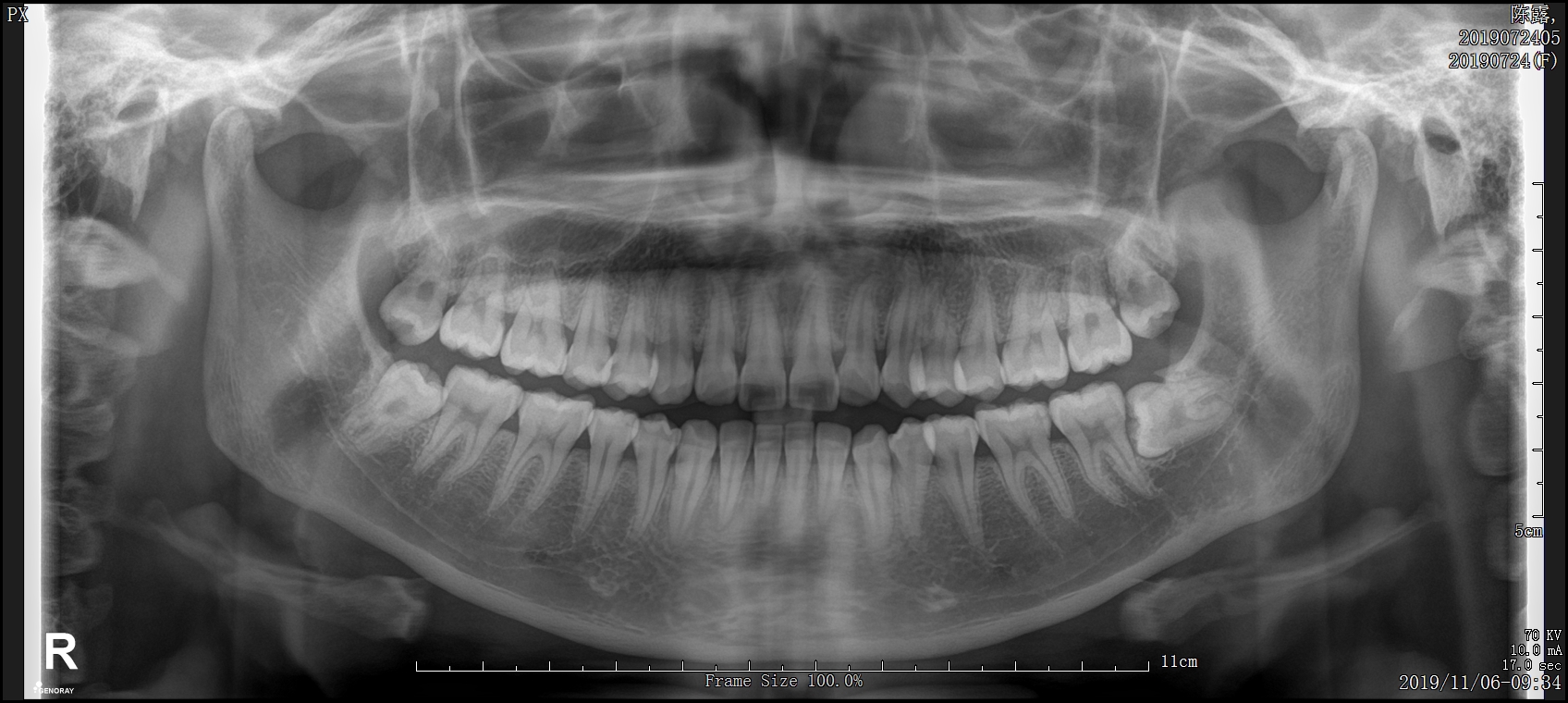 口腔胆嚢造影のリスク