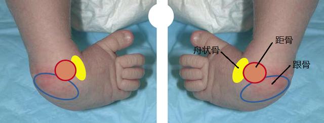 小孩子先天性马蹄内翻足不手术手法复位潘塞缇法教程