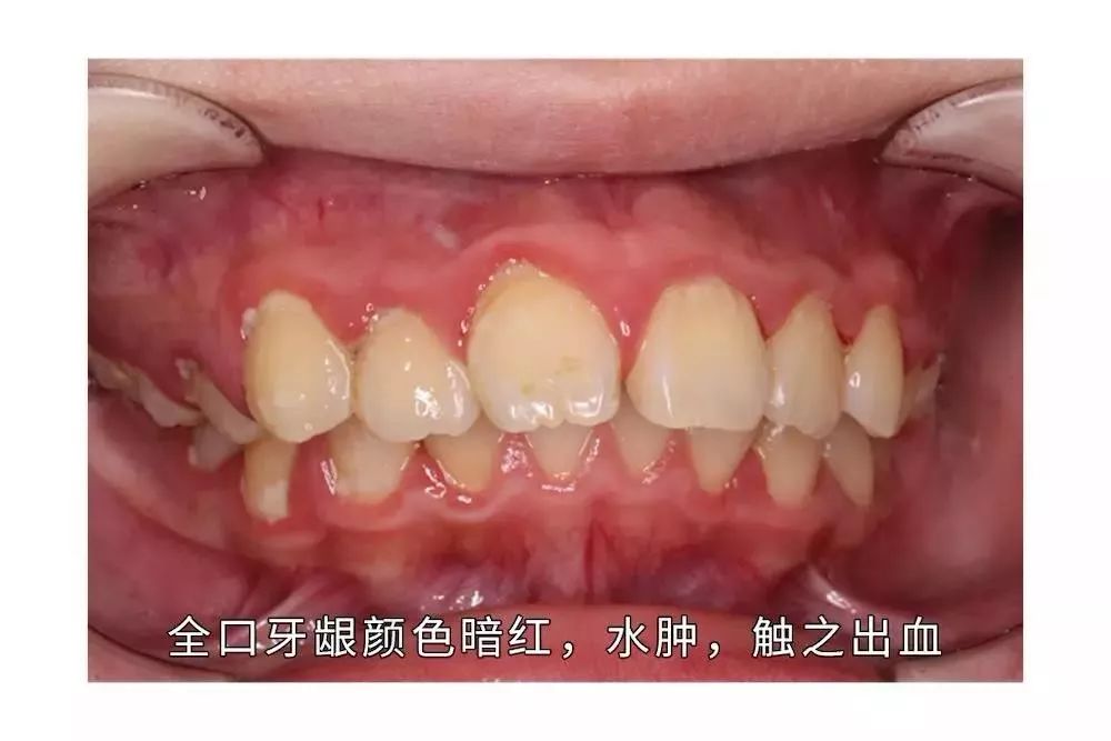 形成:由于炎症的扩展,牙周膜被破坏,牙槽骨逐渐被吸收,牙龈与牙根分离