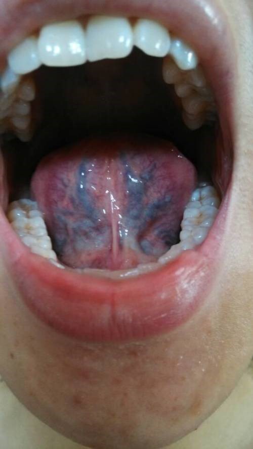 再一个,舌下的脉络怒张,迂曲明显,也是体内气血郁滞的一个明显表现