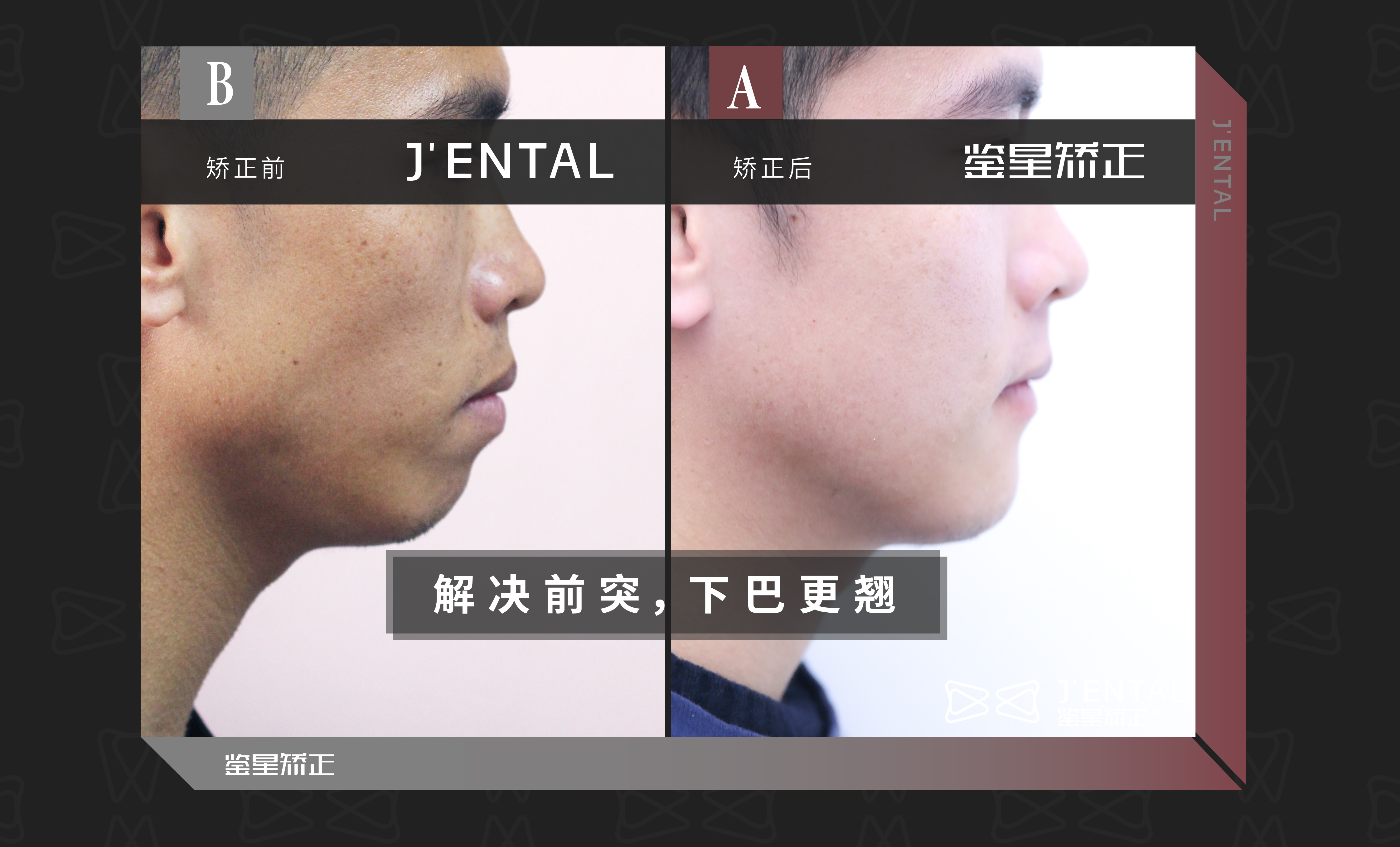 成人骨性前突告别手术,拔牙矫正加支抗钉美到你害怕