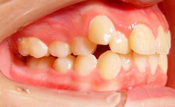 小虎牙看似可爱却潜伏隐患!拔牙还是矫正呢?