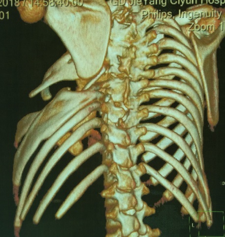罕见肋骨畸形合并胸廓畸形手术成功
