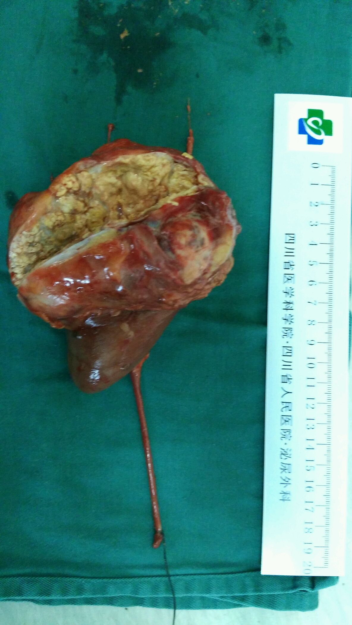左肾癌开放手术行根治性左肾切除术20161209