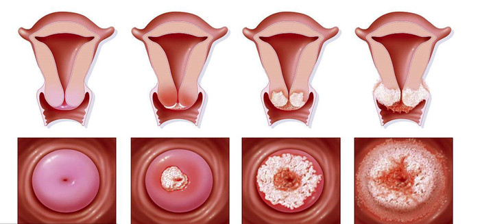 怀孕宫颈的变化图片图片