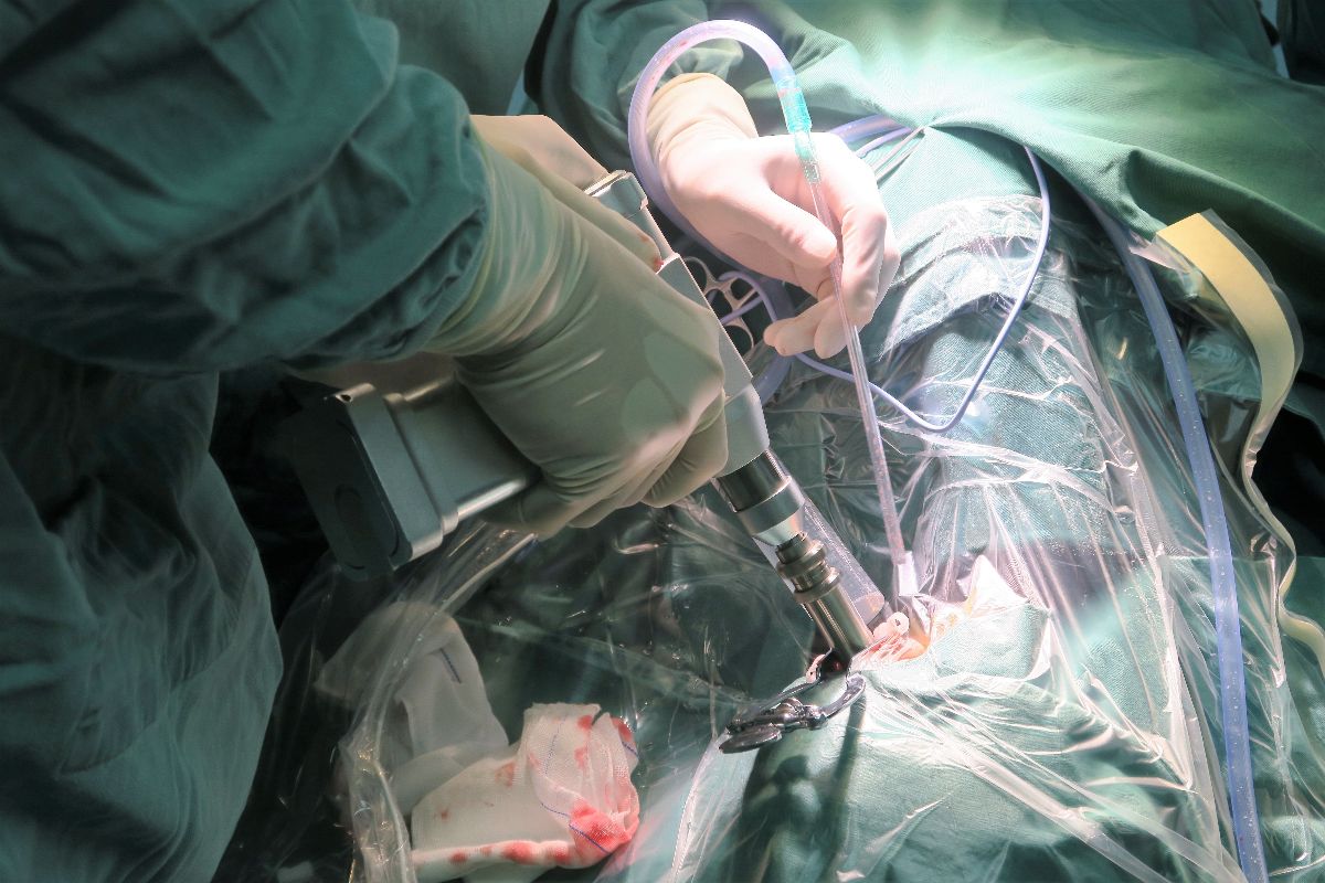 颅脑禁区小脑转移瘤粒子植入术在省医学科学院附属医