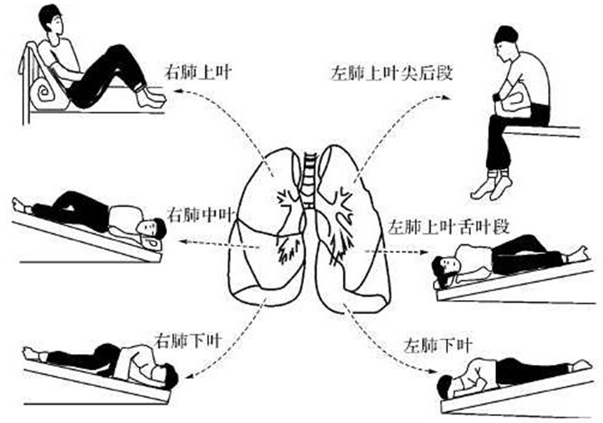 體位引流和物理治療:對於支氣管擴張明顯,痰液量多的患者,體位引流是
