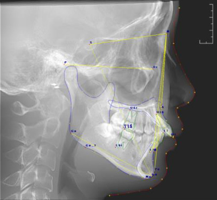 畸形的程度,分析引起错合畸形的原因是颌骨的问题还是单纯的牙齿问题