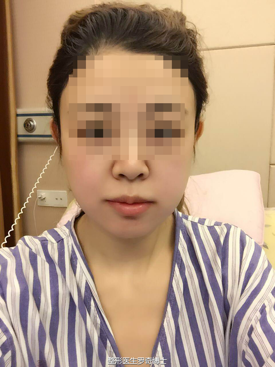 金刚腮覆灭记磨骨下颌角削骨瘦脸后现在简直美炸天附