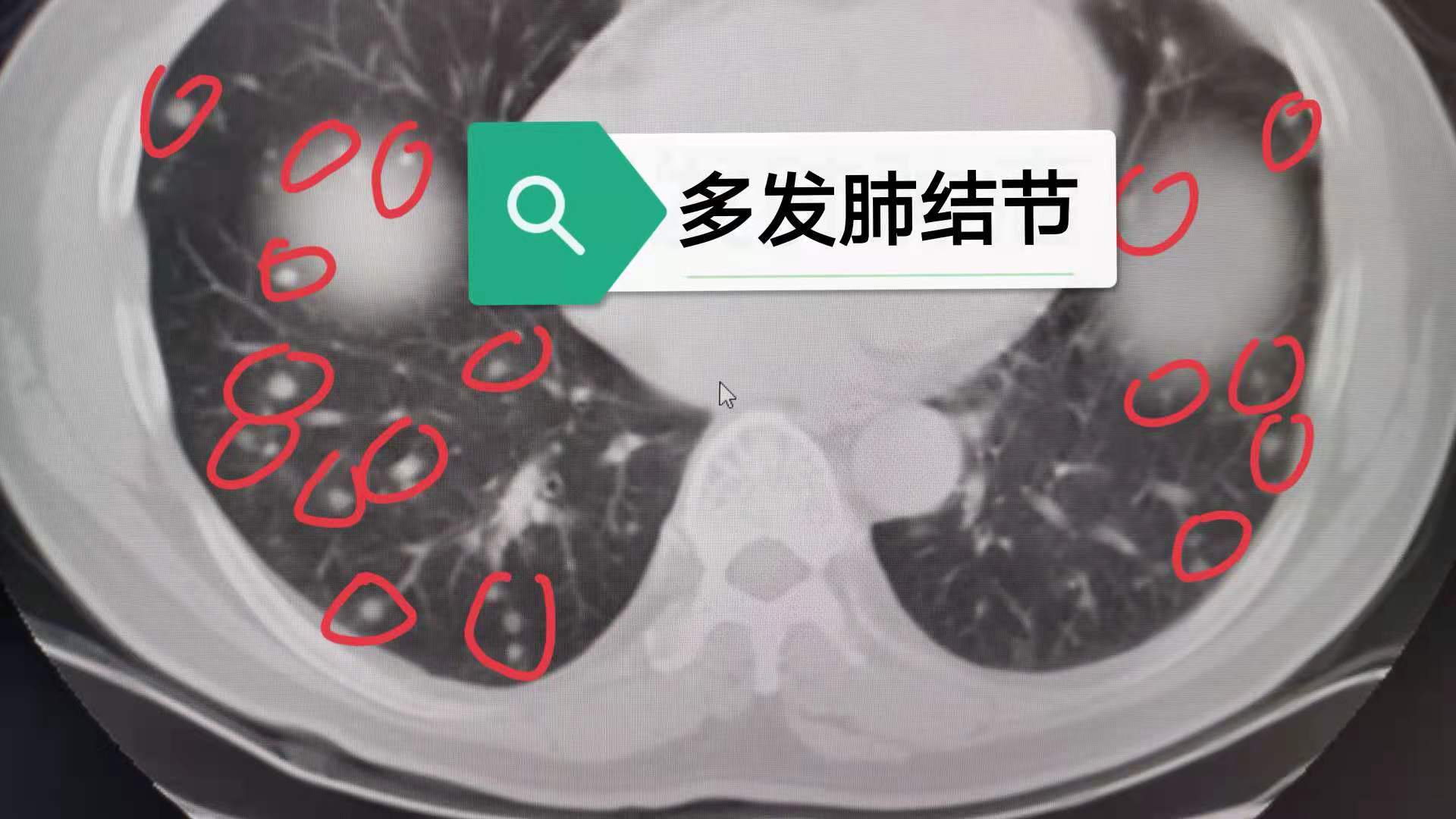 照胸部ct很多人发现了肺部小结节,非常紧张!
