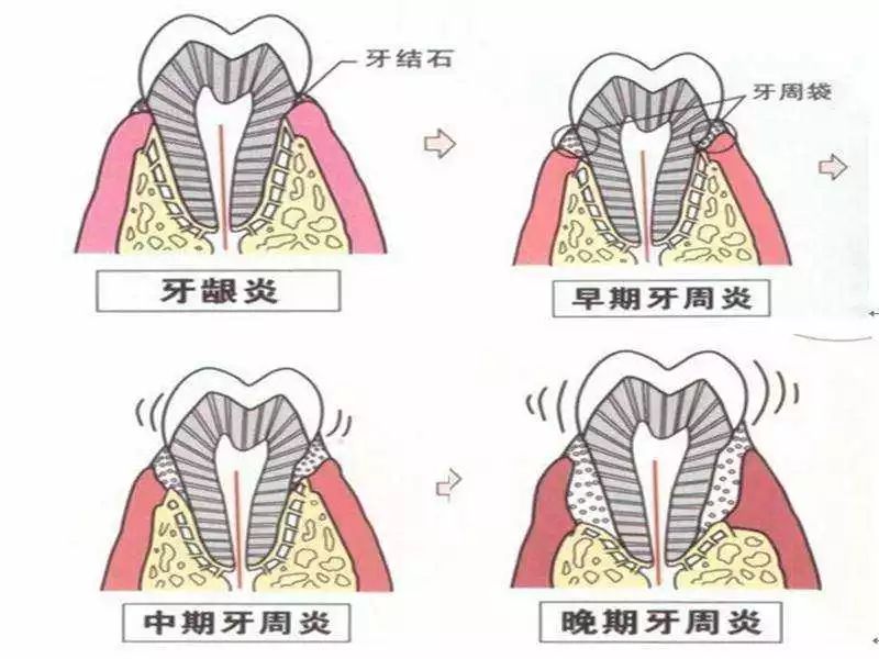 牙龈炎和牙周炎如何治疗?