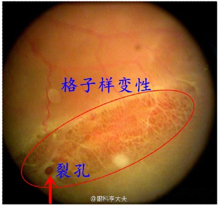 视网膜格子样变性照片图片