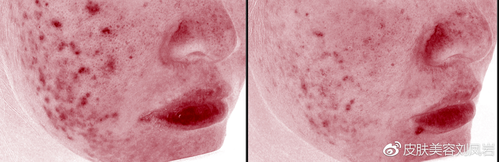 激光祛痘印前后图片