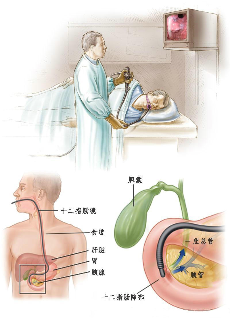 鼻胆管引流睡觉姿势图片