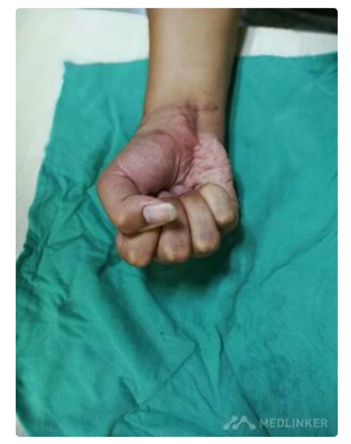 一例腕部电击伤病例展示