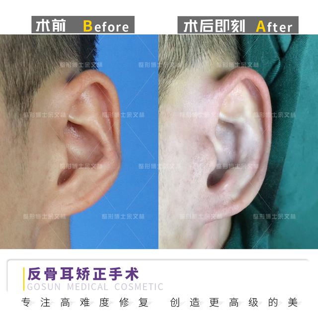 耳朵反骨的人也反骨吗?