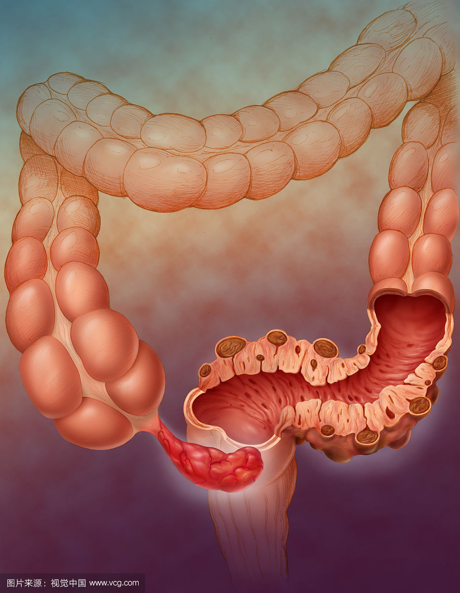 四种肠内小病一定要定期体检医生说这三类食物一定不能吃