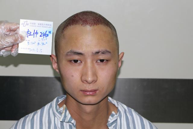 90后杜先生三级脱发5个月后是这样