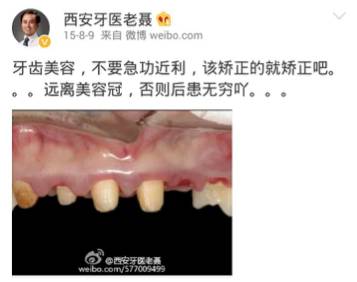 羡慕刘涛一口白牙?先看看她“美容冠”血泪史…