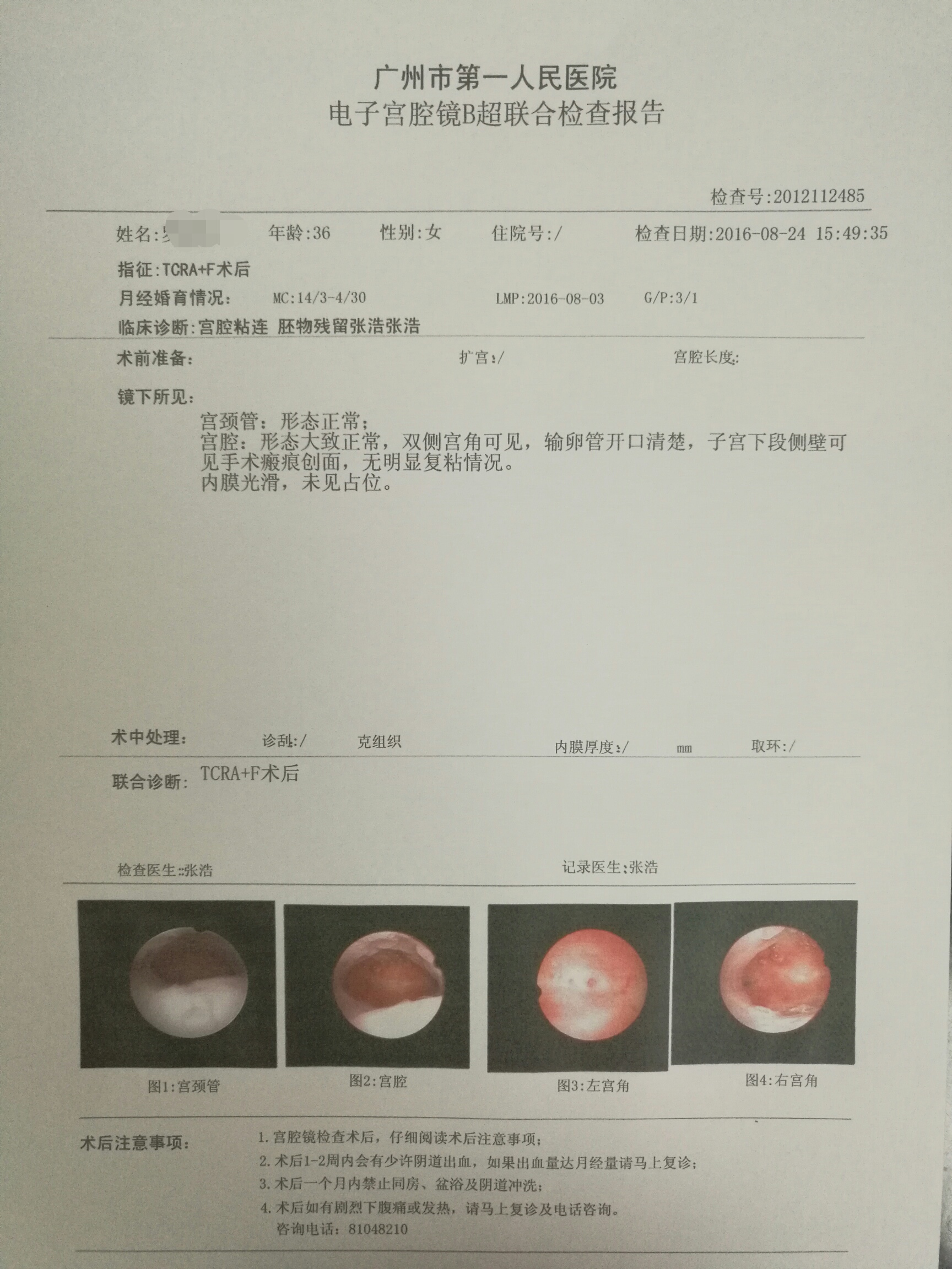 图二:经过宫腔镜电切手术,切除残留的胚胎组织,并切开粘连,术后第一个