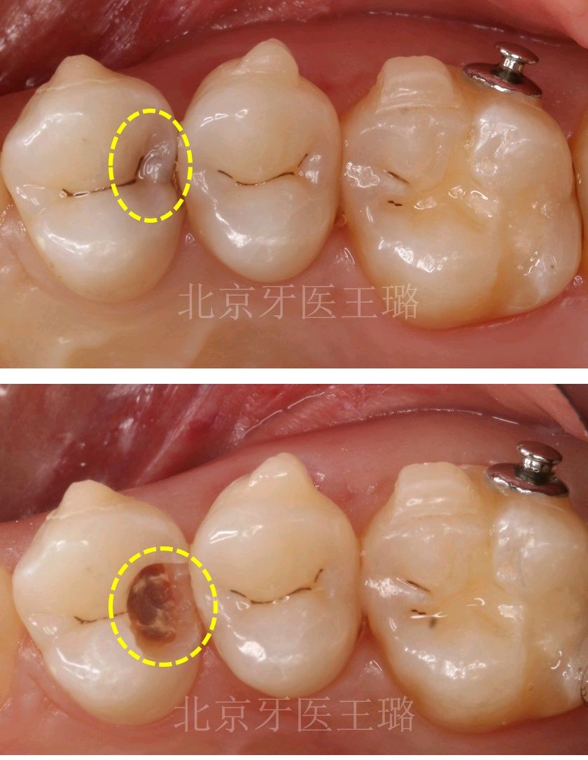 牙齒上的小洞真的小嗎