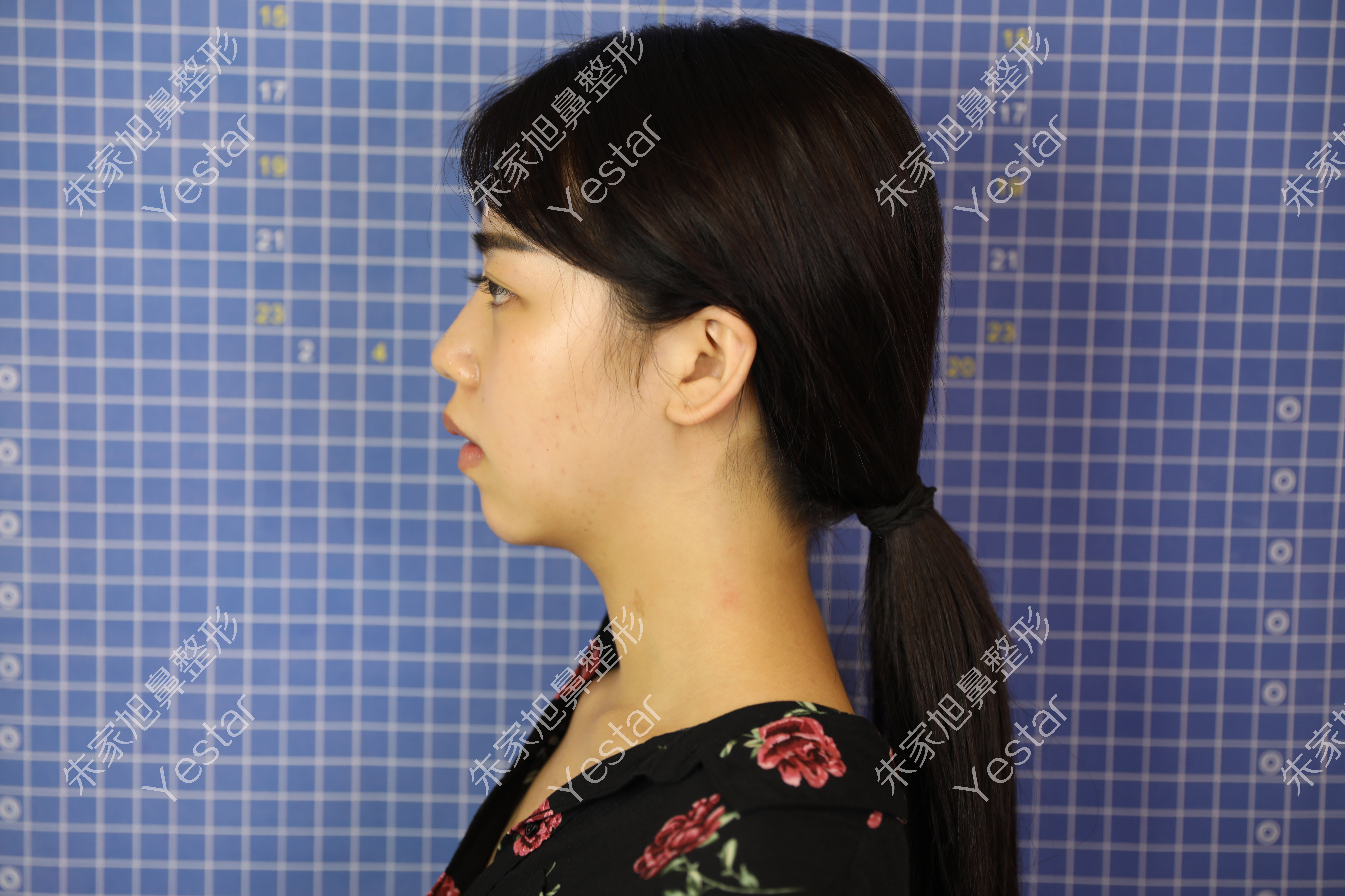 【【顾客案例分享】隆鼻 隆颏术后恢复情况】