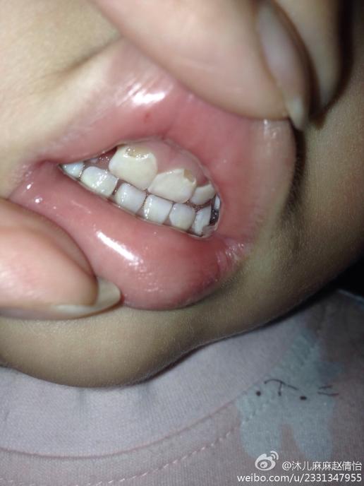 奶瓶龋齿门牙早期图片图片