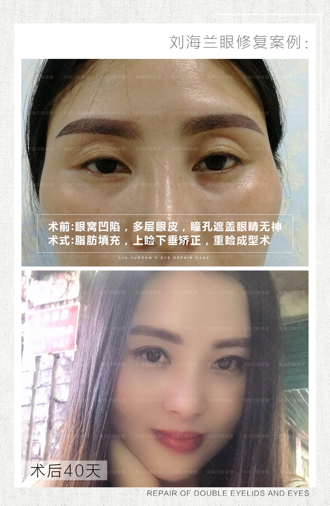 做双眼皮存在的后遗症 为什么你做的双眼皮不对称 睁眼困难 刘海兰执业医师 爱问医生