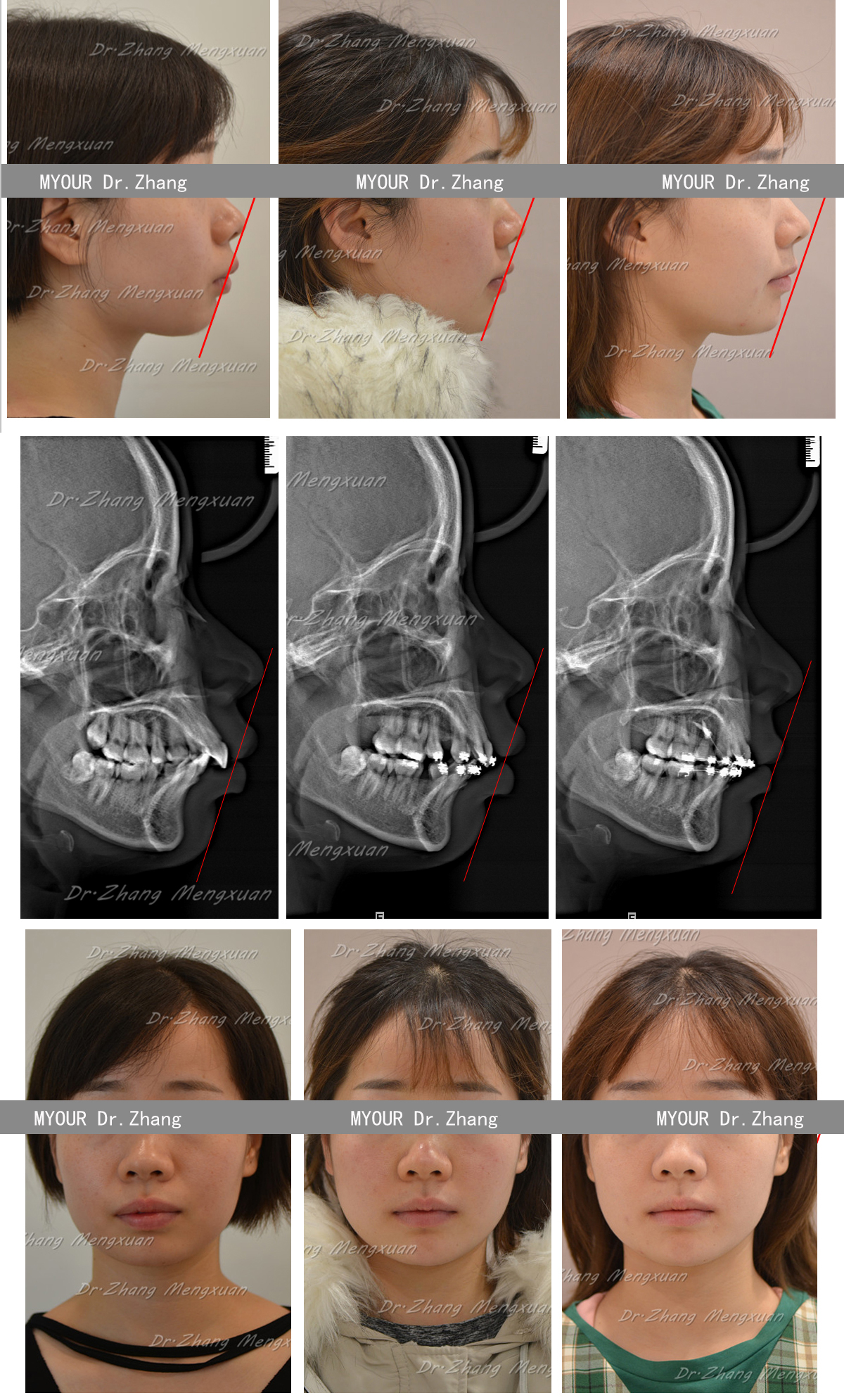 牙性前突和骨性前突图片