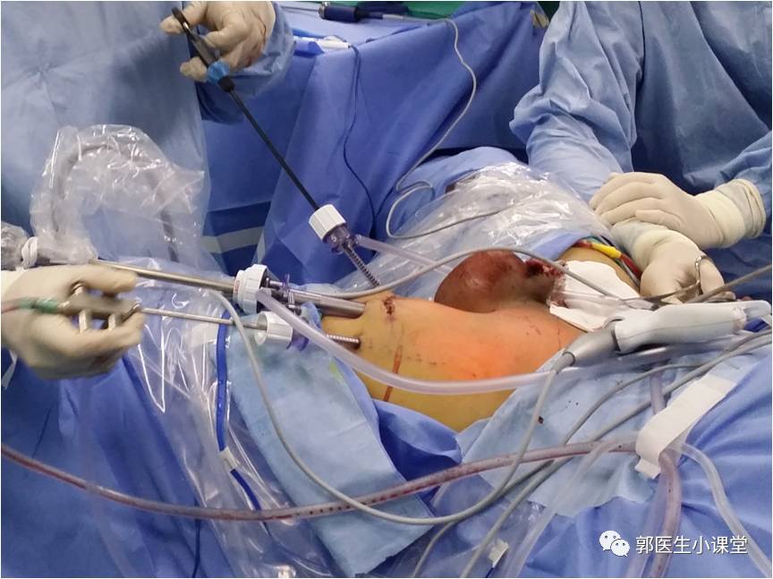 丁丁上的大菜花竟然是肿瘤