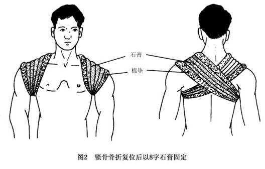 锁骨骨折枕头的垫法图片