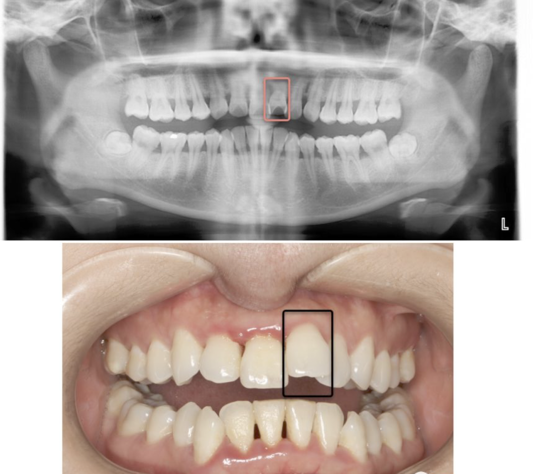 牙齿的部分牙槽骨吸收意味着牙龈炎已经导致了牙周炎原本牙槽骨应该