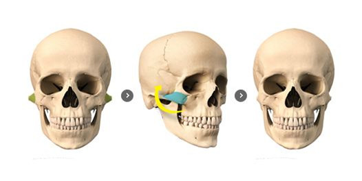 颧骨内推和颧骨磨骨的区别是什么