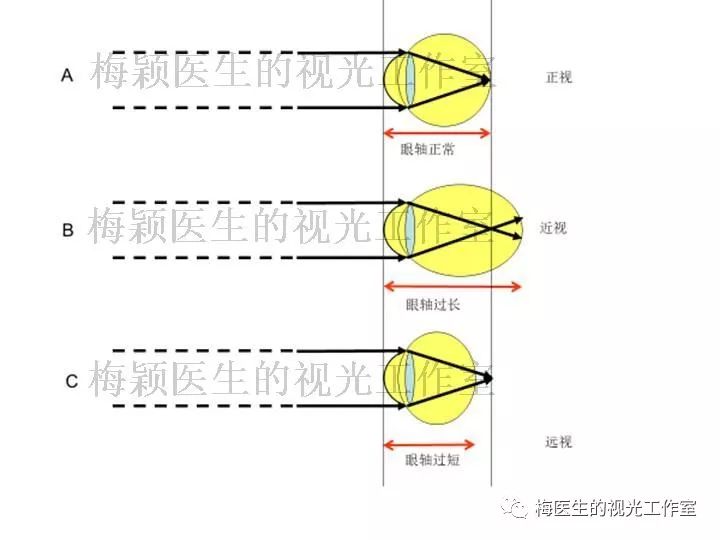 曲率性近视 新浪（移动端）