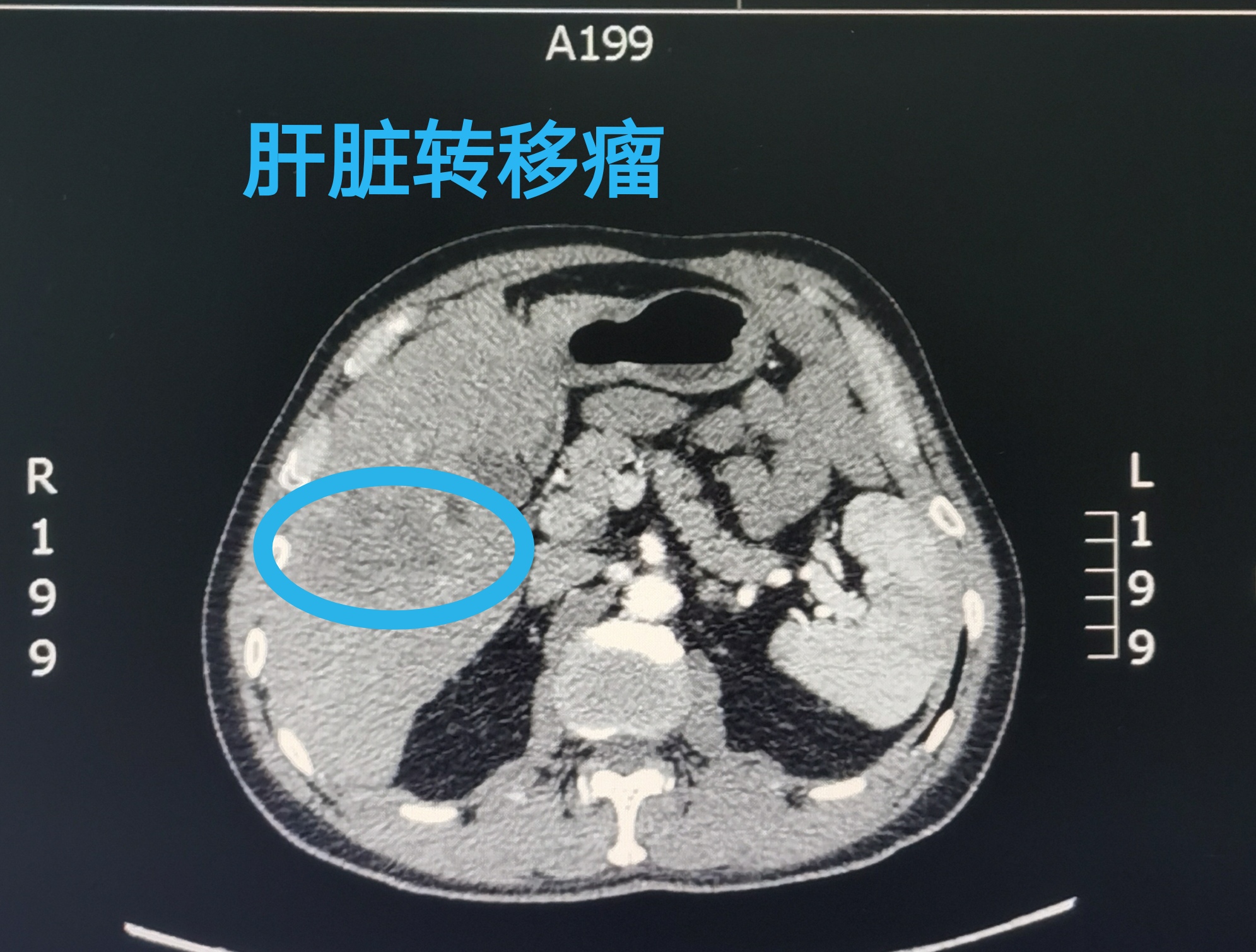结肠癌术后复发合并肝转移的治疗