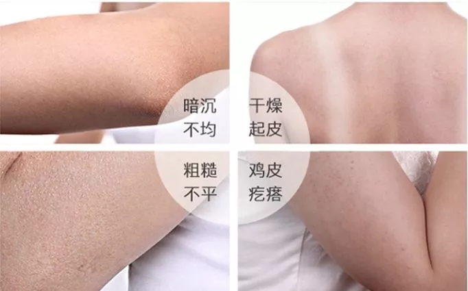 后背的鸡皮肤去除脸上(后背的鸡皮肤要怎么去除)