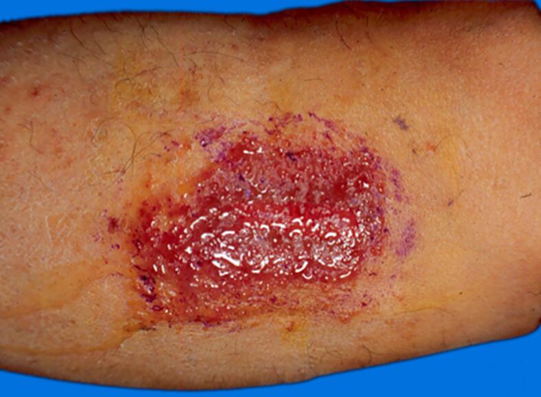 湿疹:为多形性皮疹,可有丘疹,丘疱疹,水疱,糜烂,渗液,易复发,但无传染