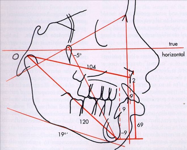 青少年正畸优势最佳选择
