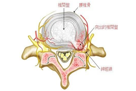 腰椎间盘突出恢复期怎么做防止病症复发?