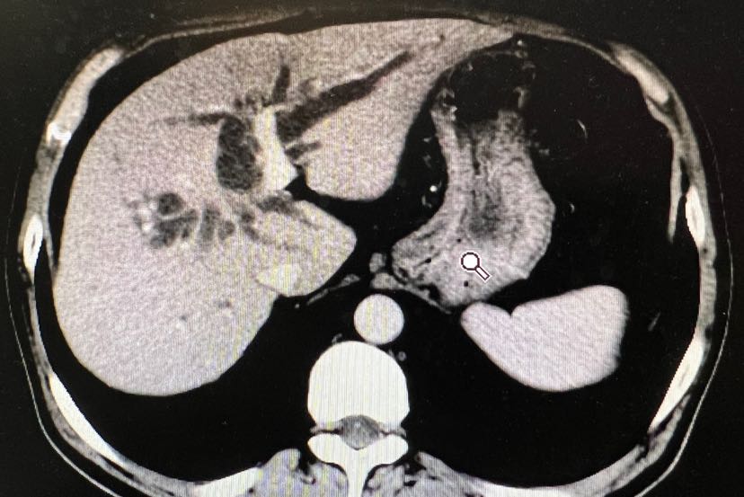 胆管癌手术前要不要做胆道引流