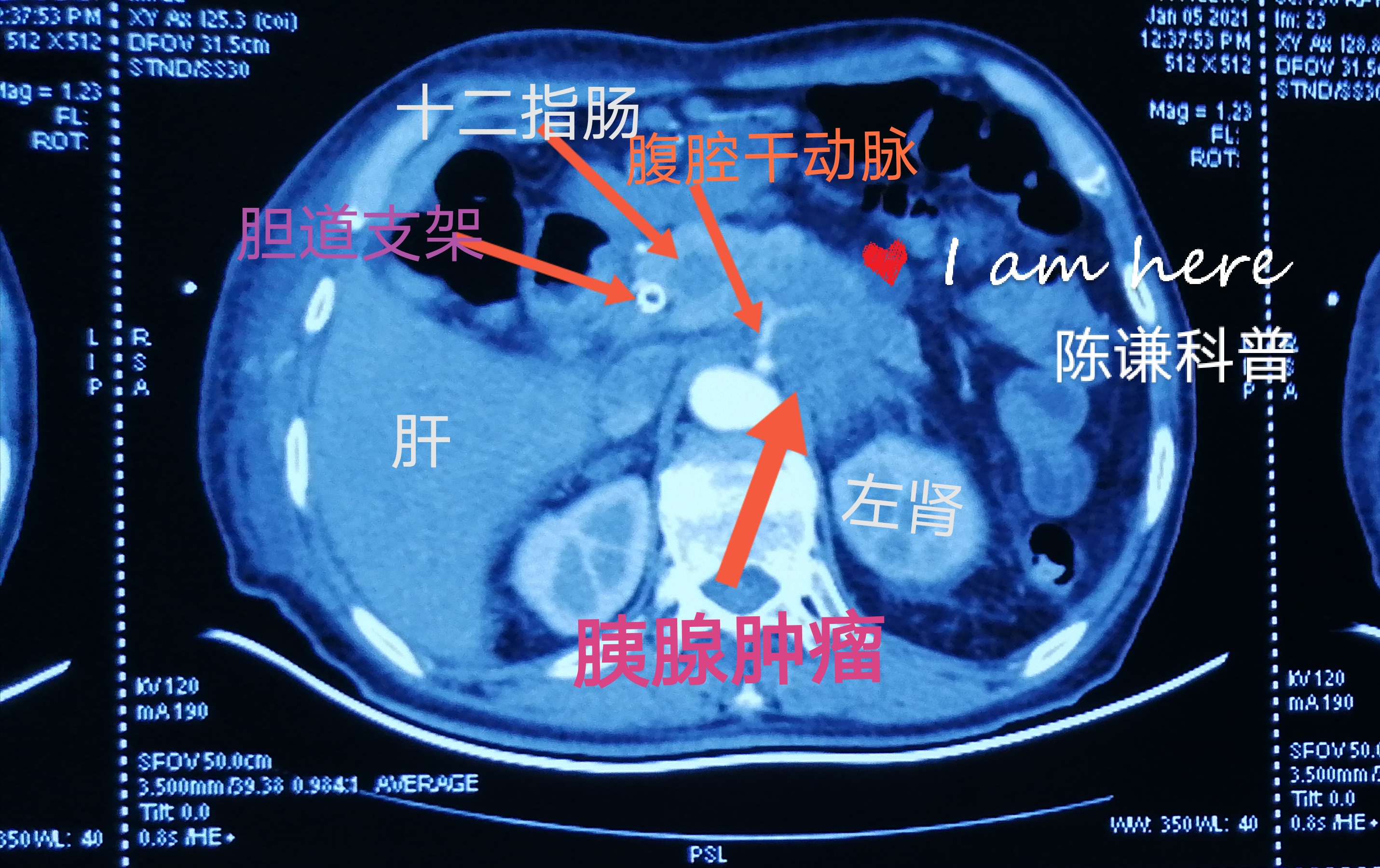 胰颈癌图片