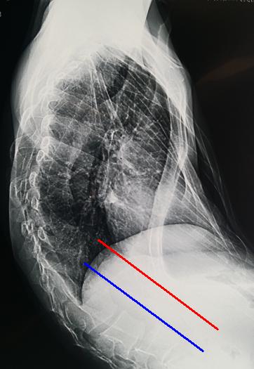 haller指数再次"爆表":又一例世界级难度的漏斗胸今天手