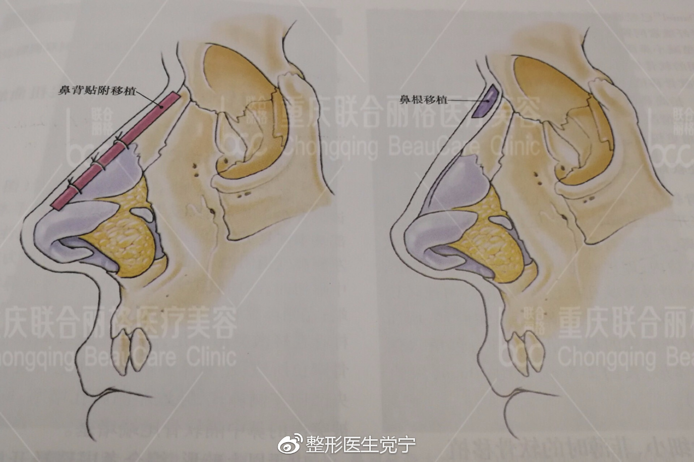 10 鼻背贴附移植以及鼻根部软骨移植